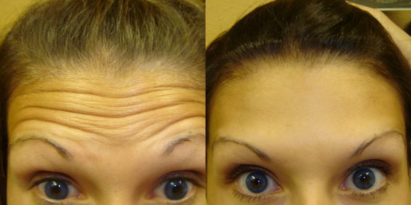 botox