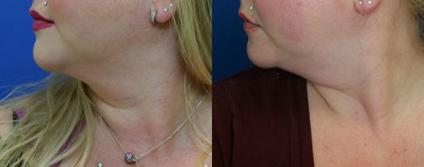 kybella side1