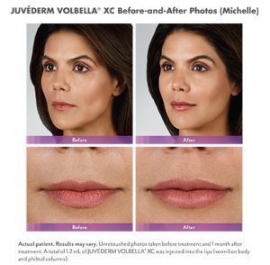 juvederm_akasmokersline