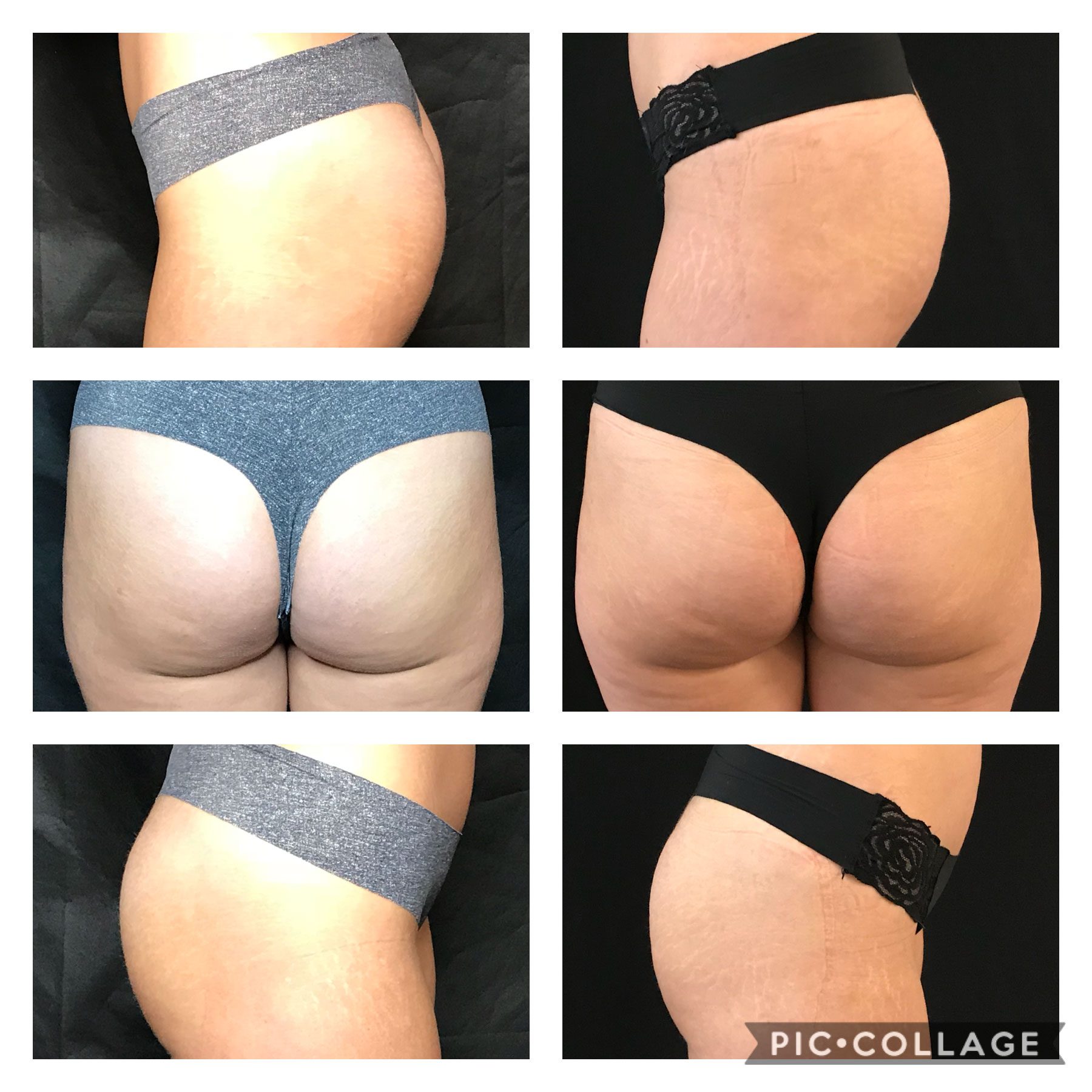 glutes-before-left-after-right Emsculpt