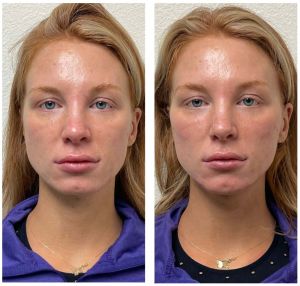 Cheek-Chin-Jaw-filler-300x286 Injectables