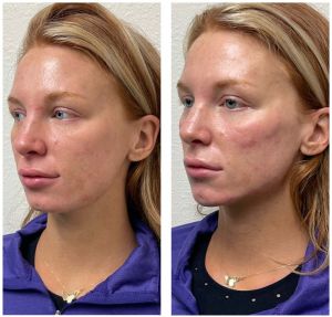 Cheek-Chin-Jaw-side-300x287 Injectables