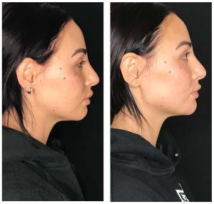 Jaw-chin-full-side-300x286 Injectables