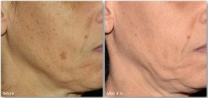 LaseMd-Ultra-1-300x141 Skin Rejuvenation