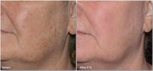 LaseMd-Ultra-2-300x139 Skin Rejuvenation