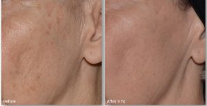 LaseMd-Ultra-3-300x153 Skin Rejuvenation
