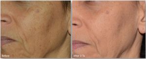 LaseMd-Ultra-4-300x121 Skin Rejuvenation