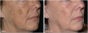 LaseMd-Ultra-5-300x113 Skin Rejuvenation