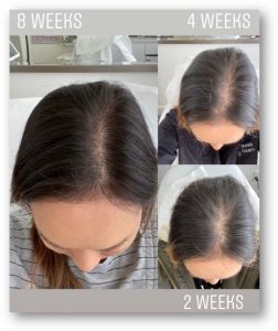 Lutronic-BAs.jpg-5-252x300 Hair Restoration